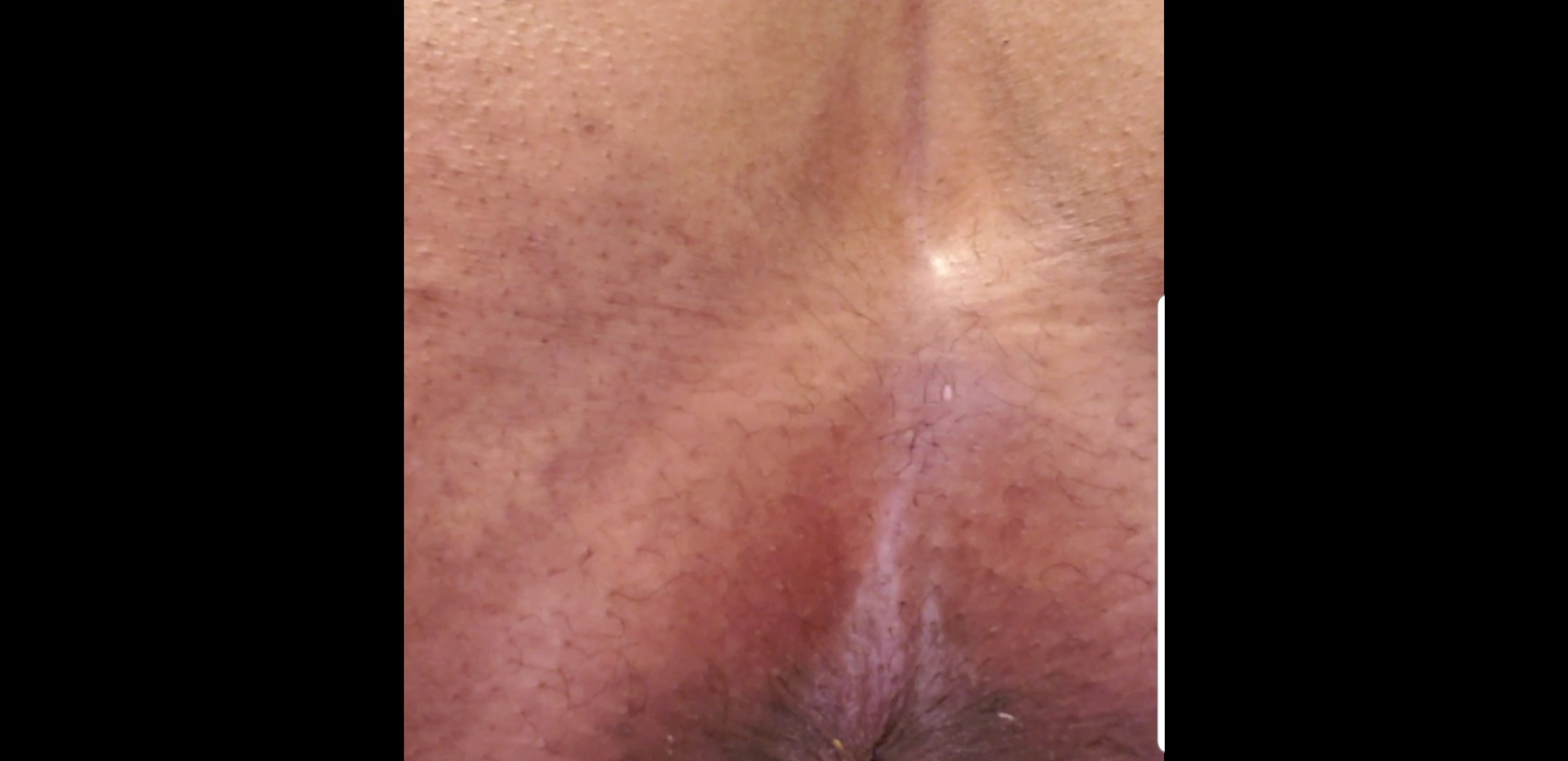 Click to play video Gassy diarrhea - video 3